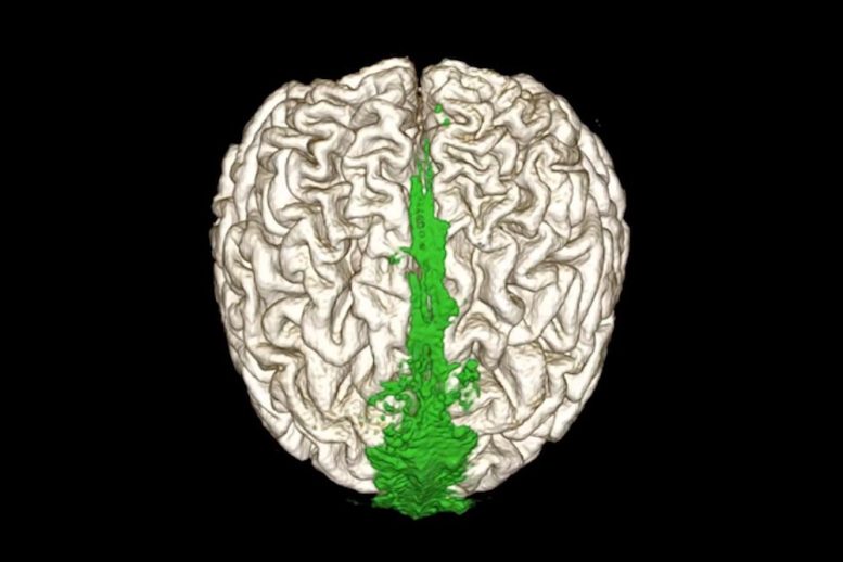 Brain's Drains