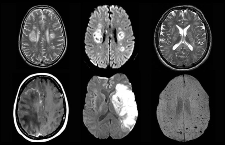 COVID-19 Brain Scans